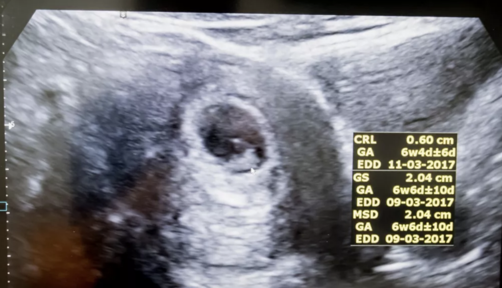 six-week-heartbeat-bill-texas-abortion-ban-media-science